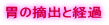 胃の摘出と経過